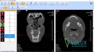 Volux  Tutorial EZDicom Viewer [upl. by Sotsirhc]