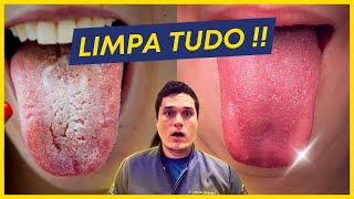 Como ACABAR com a LÍNGUA BRANCA e SABURRA LINGUAL  VERDADE REVELADA [upl. by Vareck284]