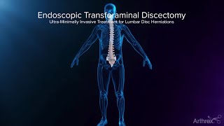 Endoscopic Transforaminal Approach for a Herniated Disc [upl. by Lounge]