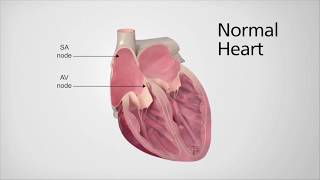 Introduction to Atrial Fibrillation with Electrophysiologist Dr Kamal Kotak [upl. by Shifrah]