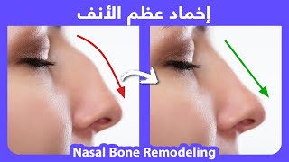 How to naturally get rid of nose hump  كيفية اخماد عظم الانف بطريقة طبيعية بدون جراحة [upl. by Llehsam]