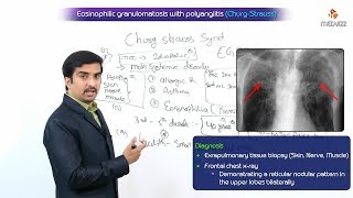 Eosinophilic granulomatosis with polyangiitis  ChurgStrauss Syndrome [upl. by Narcissus141]