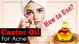 How to Use Castor Oil for Acne [upl. by Allain]