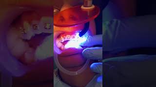 Dental tooth video dental braces and Root canal scaling polishing and crowns dental braces [upl. by Anazraf]