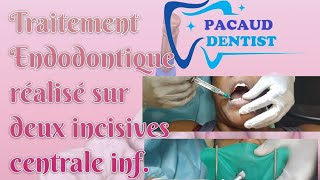 DÉVITALISATION DENTAIRE  Toutes les étapes dun Traitement Endodontique Dent antérieure [upl. by Llib]