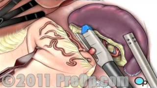 Spleen Removal Surgery Laparoscopic Splenectomy PreOp® Patient Education [upl. by Gniy]