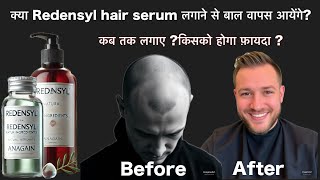 क्या Redensyl hair serum लगाने से बाल वापस आते है  Redensyl बंद करने पर क्या बाल चले जाएँगे [upl. by Ahsed]