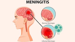 Meninges  Meningitis symptoms Diagnosis And Treatments [upl. by Harutek]