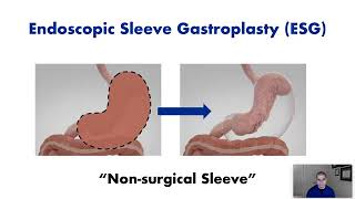 Endoscopic Sleeve Gastroplasty ESG  Procedure Overview [upl. by Frey249]