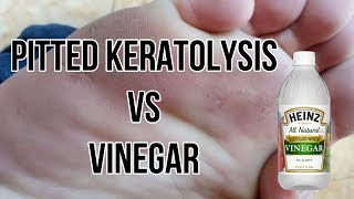 Easy way to cure pitted keratolysis cara menyembukan kaki rayapan [upl. by Moreland]