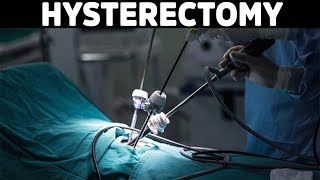 Think Twice before Getting a Hysterectomy [upl. by Cock804]