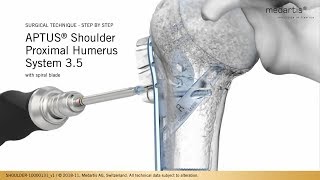 APTUS Proximal Humerus System 35  Surgical Technique [upl. by Onaicram436]