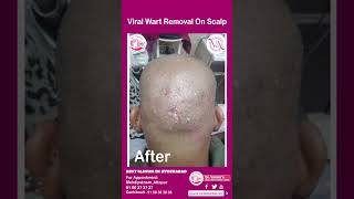 Viral Wart Removal On Scalp  Scalp Wart Removal Treatment  Dr Vimalas Skin Hair amp Laser Centre [upl. by Llewej149]