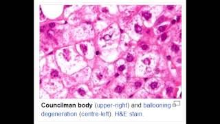 Lab or Diagnostic Findings Councilman Body Toxic or Viral Hepatitis Yellow Fever [upl. by Gelman]