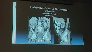 HIPERPLASIA PROSTÁTICA BENIGNA GENERALIDADES DIAGNOSTICO Y TRATAMIENTO [upl. by Massingill]