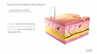 Fotona Laser Scar and Striae Revision [upl. by Nanice]