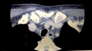 Lymphoma or Castlemans Disease Blog 3 with CT scan [upl. by Finegan]