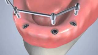 Prothèse dentaire sur implants [upl. by Letitia]