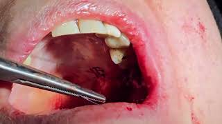 closure of an oroantral communication using a double layer buccal pad of fatadvanced buccal flap [upl. by Simson]