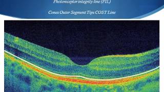 OCT Tutorial On Macular Anatomy part 1 [upl. by Jaunita]