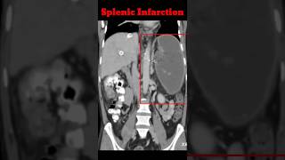 Splenic infarction  Cect Abdomen  Abdomen CT shorts radiology splenicinfrection [upl. by Lehar]