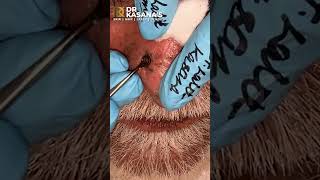 Nose Blackheads  Removal by DrLalit Kasana [upl. by Aleacim]