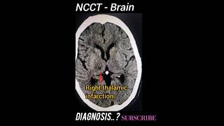 Thalamic Stroke  NCCT Brain  Diagnosis  Practical case [upl. by Seira]