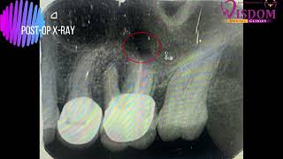 Apicoectomy of palatal root of maxillary 1st molar [upl. by Enaile]