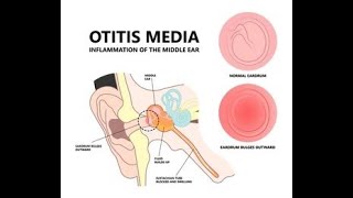 chapter5 pediatrics otitis media [upl. by Burgwell]