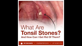 What are Tonsil Stones And how can I get rid of them [upl. by Robbin]