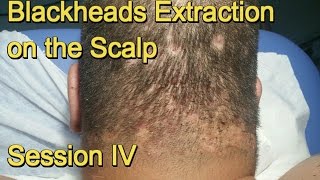 Blackheads Extraction on the Scalp  Session IV [upl. by Iroj]