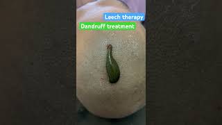 Dandruff curing with leech therapyhair care dandruff hairfallsolution drkgsharma [upl. by Adyht]