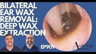 BILATERAL EAR WAX REMOVAL DEEP WAX EXTRACTION  EP909 [upl. by Siward]