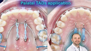 Wide range of palatal TADs applications mini screws palatelly benefits of mini implants in palate [upl. by Nirra352]