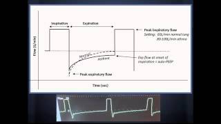 Vent Settings in Asthma quotEM in 5quot [upl. by Fritz]