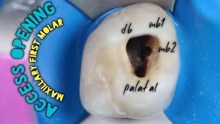 Access Opening of Maxillary First Molar  how to easily locate Mesiobuccal Canals mb1 amp mb2 [upl. by Lumbye]