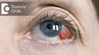 Causes of red clots in eyes  Dr Mala Suresh [upl. by Alah]