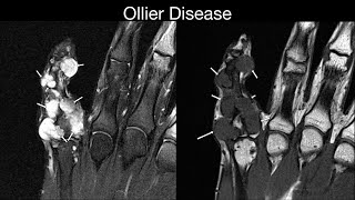 Ollier Disease [upl. by Anih]