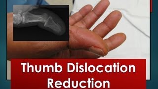 Thumb Dislocation Reduction [upl. by Harras]