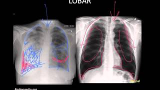 Pneumonia Imaging [upl. by Loella]