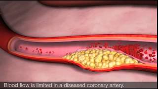 Angina and coronary heart disease [upl. by Eisdnyl]