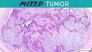 Chondroid Syringoma Mixed Tumor  Like Pleomorphic Adenoma of Skin 5Minute Pathology Pearls [upl. by Drucy921]