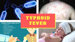 Typhoid Fever Symptoms – Causes Symptoms and Pictures of Enteric fever in Men women [upl. by Porush680]