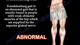 Trendelenburg Gait  Everything You Need To Know  Dr Nabil Ebraheim [upl. by Ahsaya603]