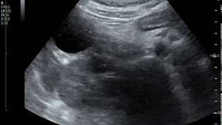 Acute Cholecystitis Ultrasound JETem 2018 [upl. by Ozmo]