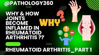 Rheumatoid arthritisRA part 1 What causes RA Concept of RA Simplified RA medicine md [upl. by Fleece]