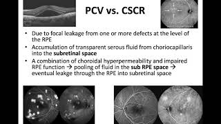 Polypoidal Choroidal Vasculopathy  Dr Fadwa AlAdel [upl. by Annawt]