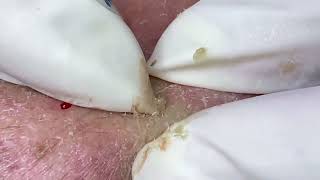 INFLAMED CYSTIC ACNE Extraction Blackheads Whiteheads Milia [upl. by Angle]