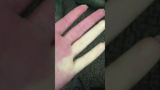 Raynauds disease overview [upl. by Xela]