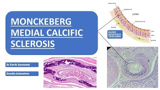 Monckeberg Medial Calcific Sclerosis  Doodle Animation  Images  Made Easy [upl. by Shaia]